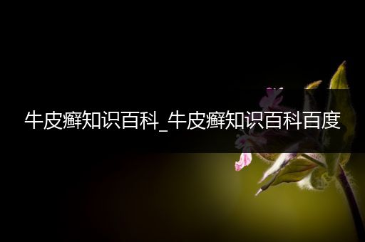 牛皮癣知识百科_牛皮癣知识百科百度